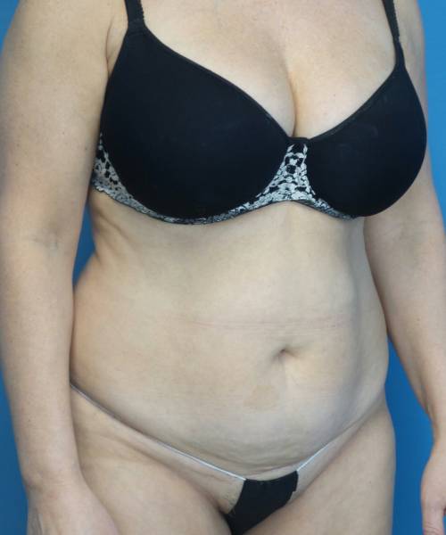 before tummy tuck right view female patient case 3686