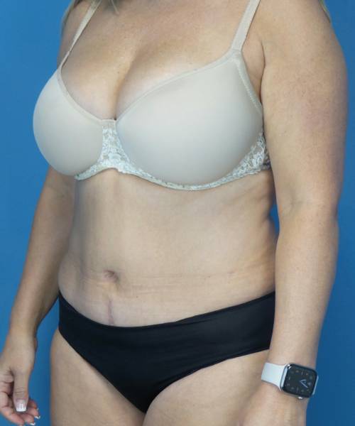 after tummy tuck left view female patient case 3686