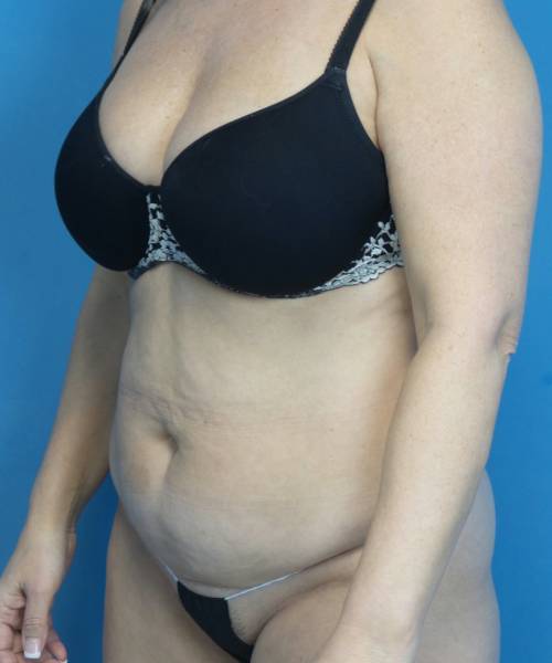 before tummy tuck left view female patient case 3686