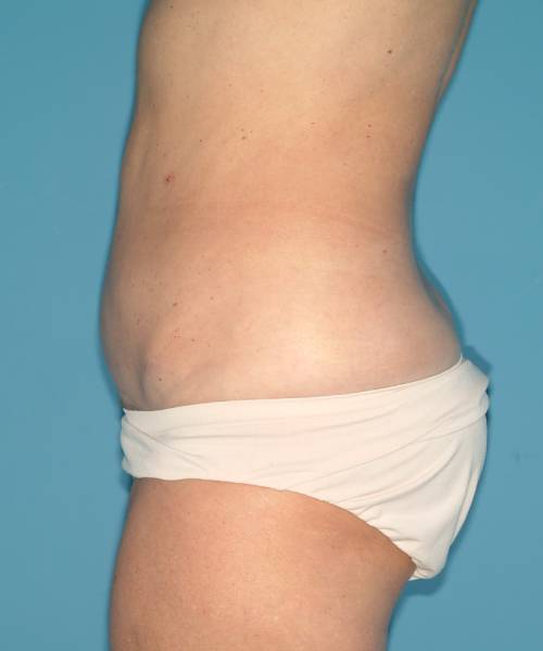 after tummy tuck left side view case 3695