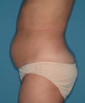 before tummy tuck left side view case 3695
