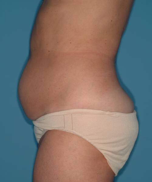 before tummy tuck left side view case 3695