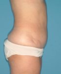 after tummy tuck right side view case 3695