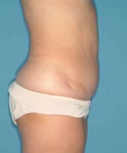 after tummy tuck right side view case 3695