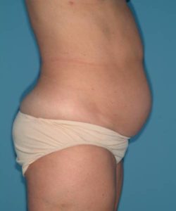 before tummy tuck right side view case 3695