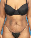 before tummy tuck front view case 3675 | Crispin Plastic Surgery Atlanta, GA