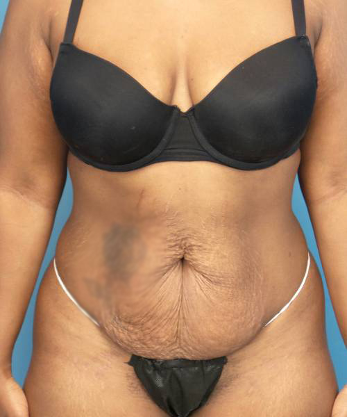 before tummy tuck front view case 3675 | Crispin Plastic Surgery Atlanta, GA