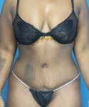 after tummy tuck front view case 3675 | Crispin Plastic Surgery Atlanta, GA