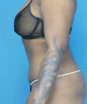 after tummy tuck left view case 3675 | Crispin Plastic Surgery Atlanta, GA