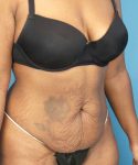 before tummy tuck right diagonal view case 3675 | Crispin Plastic Surgery Atlanta, GA