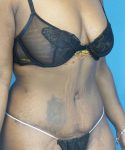 after tummy tuck right diagonal view case 3675 | Crispin Plastic Surgery Atlanta, GA