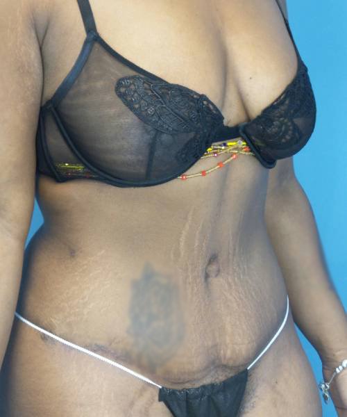 after tummy tuck right diagonal view case 3675 | Crispin Plastic Surgery Atlanta, GA