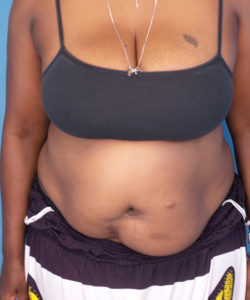 before tummy tuck female patient front view case 1640 | Crispin Plastic Surgery Atlanta, GA