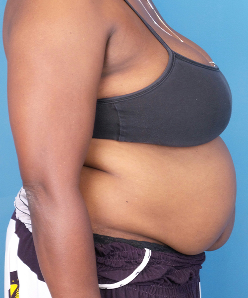 before tummy tuck female patient right side view case 1640 | Crispin Plastic Surgery Atlanta, GA