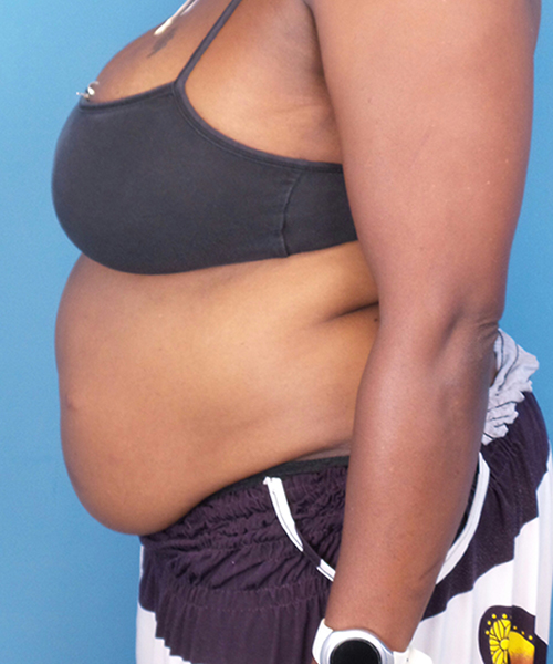 before tummy tuck female patient left side view case 1640 | Crispin Plastic Surgery Atlanta, GA