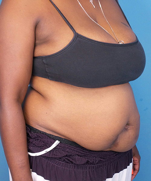 before tummy tuck female patient front right diagonal view case 1640 | Crispin Plastic Surgery Atlanta, GA