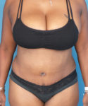 after tummy tuck female patient front view case 1640 | Crispin Plastic Surgery Atlanta, GA