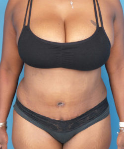 after tummy tuck female patient front view case 1640 | Crispin Plastic Surgery Atlanta, GA