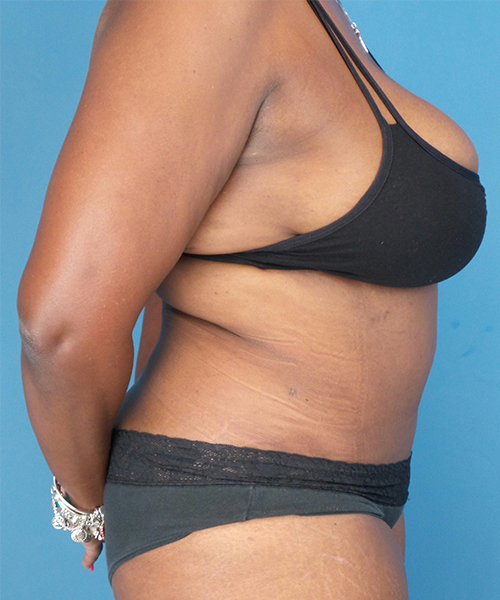 after tummy tuck female patient right side view case 1640 | Crispin Plastic Surgery Atlanta, GA
