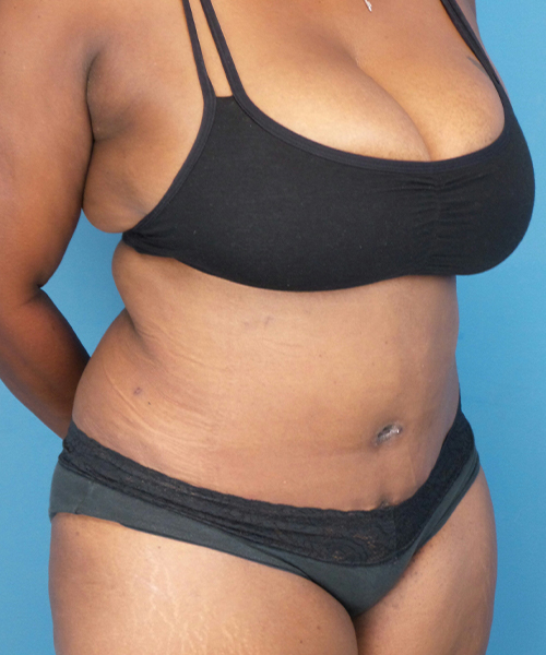 after tummy tuck female patient front right diagonal view case 1640 | Crispin Plastic Surgery Atlanta, GA