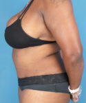 after tummy tuck female patient left side view case 1640 | Crispin Plastic Surgery Atlanta, GA