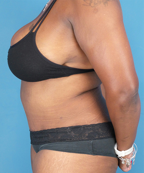 after tummy tuck female patient left side view case 1640 | Crispin Plastic Surgery Atlanta, GA