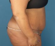 after tummy tuck procedure right side view case 4708 | Crispin Plastic Surgery Atlanta, GA
