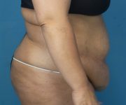 before tummy tuck procedure right side view case 4708 | Crispin Plastic Surgery Atlanta, GA