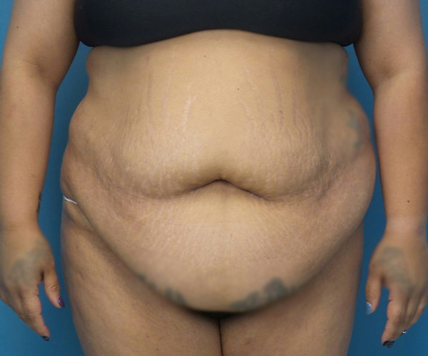 before tummy tuck procedure front view case 4708 | Crispin Plastic Surgery Atlanta, GA