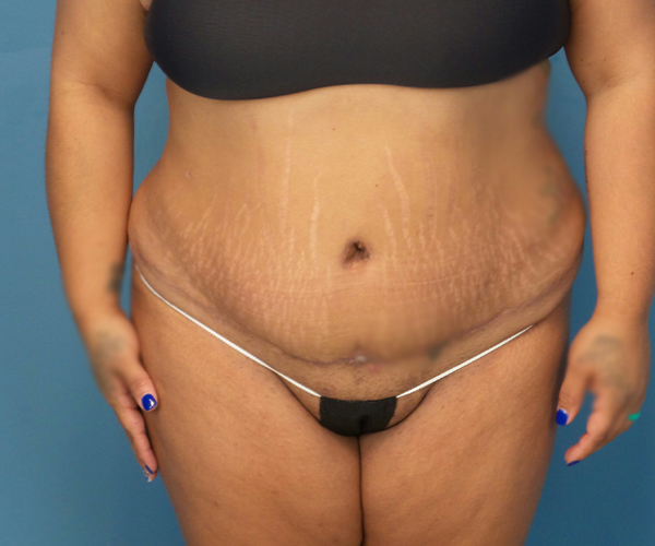 after tummy tuck procedure front view case 4708 | Crispin Plastic Surgery Atlanta, GA