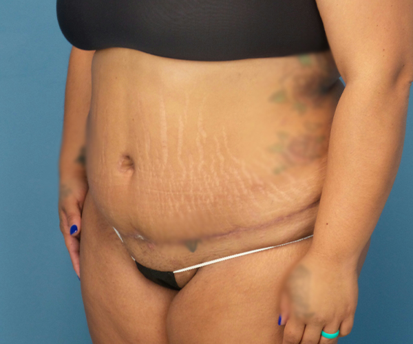 after tummy tuck procedure front left diagonal view case 4708 | Crispin Plastic Surgery Atlanta, GA