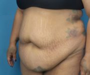 before tummy tuck procedure front left diagonal view case 4708 | Crispin Plastic Surgery Atlanta, GA