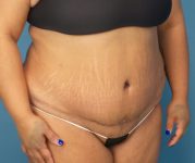 after tummy tuck procedure front right angle view case 4708 | Crispin Plastic Surgery Atlanta, GA