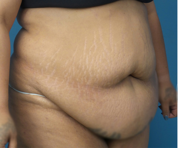 before tummy tuck front right angle view case 4708 | Crispin Plastic Surgery Atlanta, GA