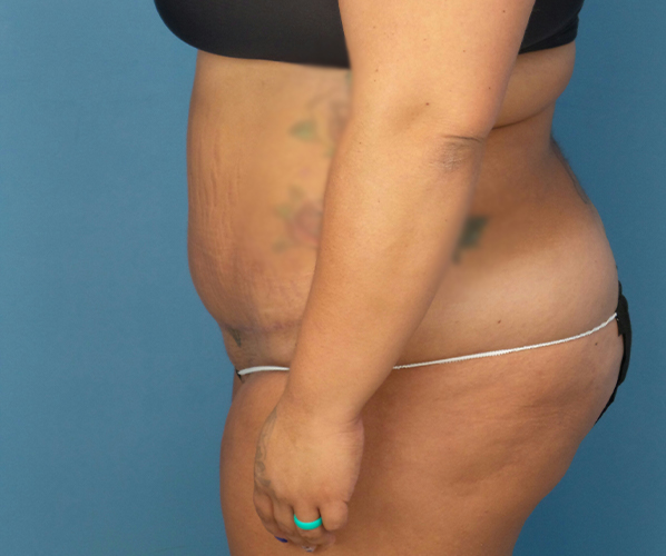 after tummy tuck procedure left side view case 4708 | Crispin Plastic Surgery Atlanta, GA