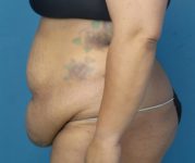 before tummy tuck procedure left side view case 4708 | Crispin Plastic Surgery Atlanta, GA