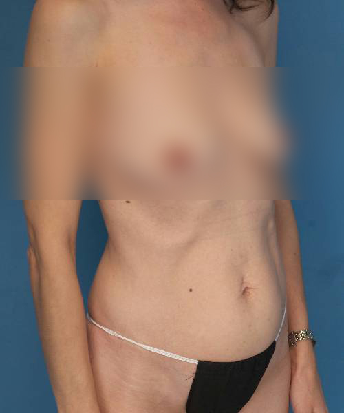 before tummy tuck right angle view female patient case 1676