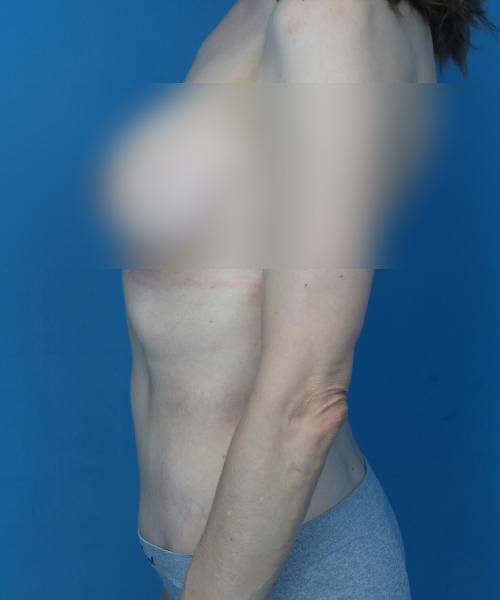 after tummy tuck left side view female patient case 1676