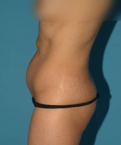 before tummy tuck left side view female patient case 1734
