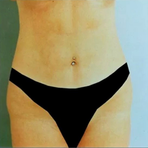 after liposuction front view female patient case 5126