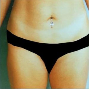 before liposuction front view female patient case 5126