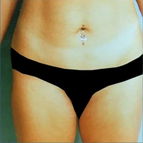 before liposuction front view female patient case 5126