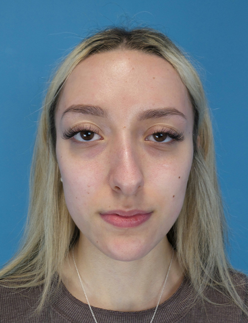 before rhinoplasty front view female patient case 5210