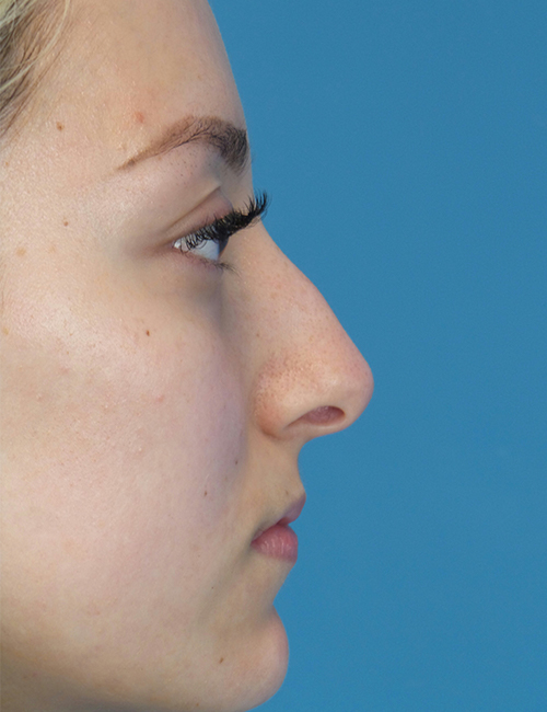 before rhinoplasty right side view female patient case 5210