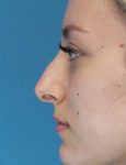 before rhinoplasty left side view female patient case 5210