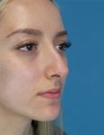 before rhinoplasty right angle view female patient case 5210