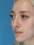 before rhinoplasty left angle view female patient case 5210