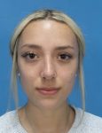after rhinoplasty front view female patient case 5210