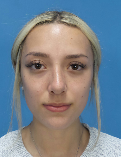 after rhinoplasty front view female patient case 5210
