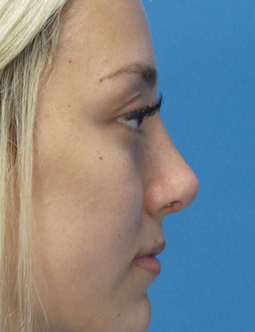 after rhinoplasty right side view female patient case 5210